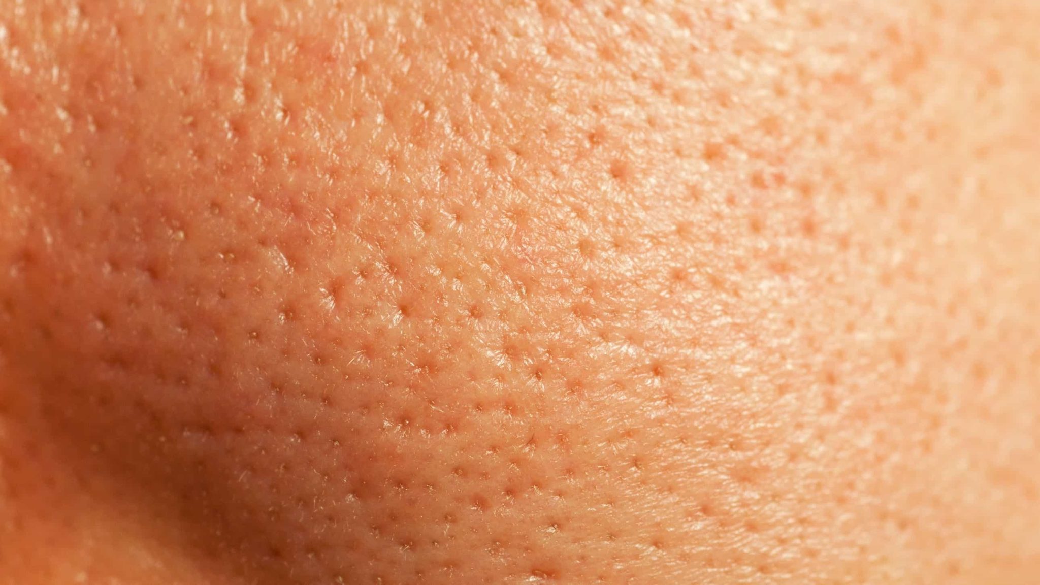 Blackheads Holes 5 Simple Home Remedies To Get Rid It