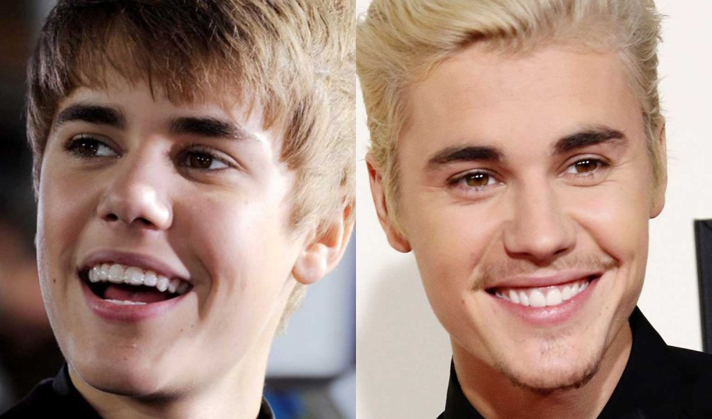 Top 10 Celebrities Who Have Used Invisalign and Braces
